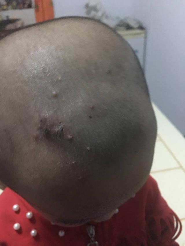 男孩去水上乐园玩水感染传染性软疣,去水上乐园会感染尖锐湿吗疣吗